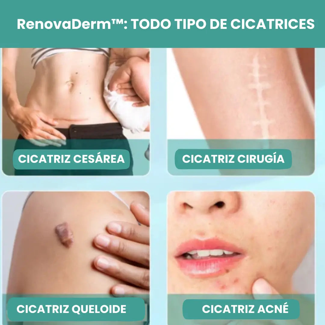 RenovaDerm™: Spray para cicatrices + Envío GRATIS